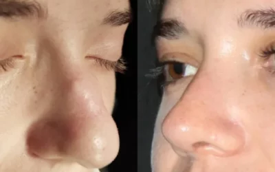 Los 5 beneficios de la Rinoplastia ultras&oacute;nica: ventajas y recuperaci&oacute;n