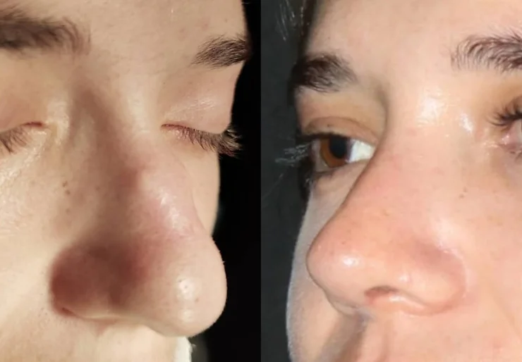 rinoplastia ultrasónica