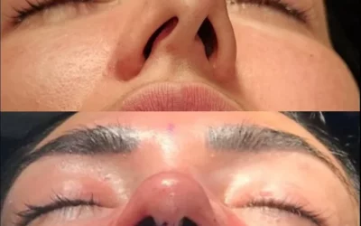 Rinoplastia vs. Septoplastia: Gu&iacute;a esencial 2026