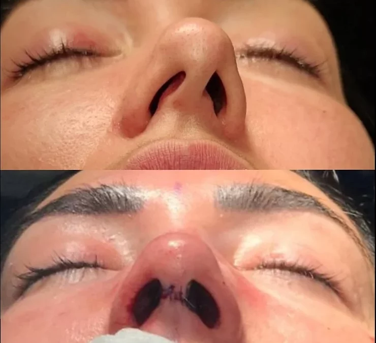 Rinoplastia vs. Septoplastia: Guía esencial 2026