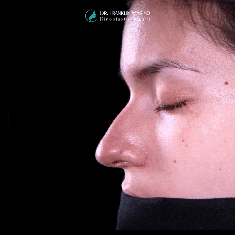 ejemplos de pacientes de perfil rinoplastia animacion