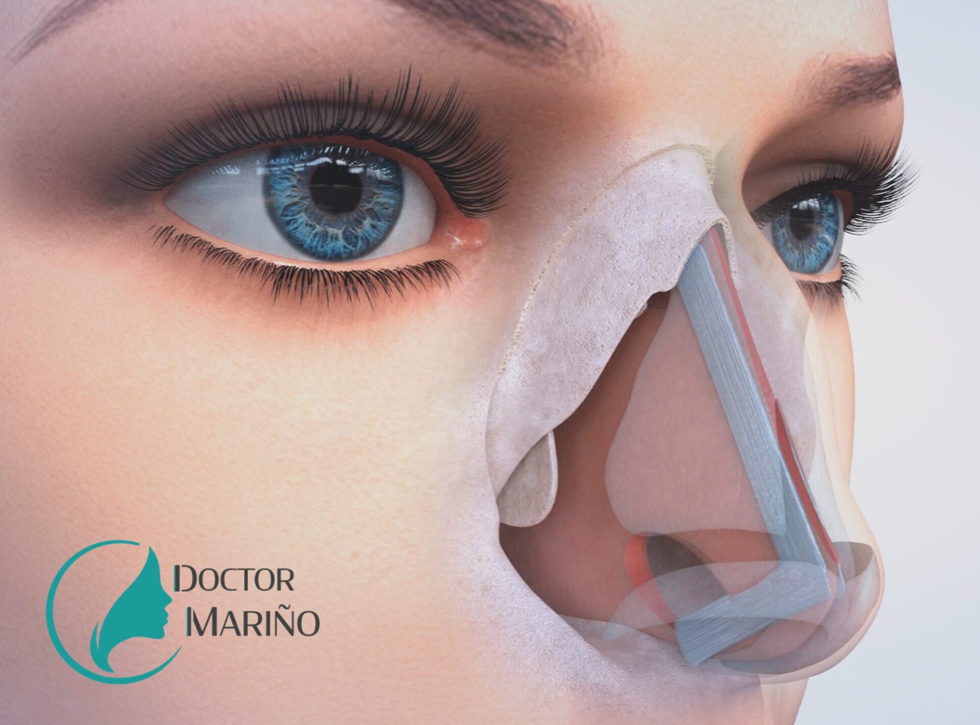 cierre de perforación septal y rinoplastia
